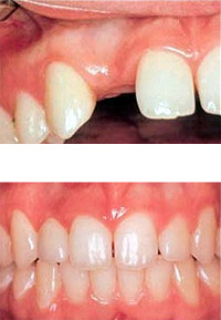 Dental Implants