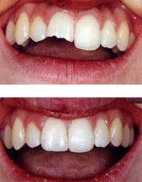 Bonding/White Fillings